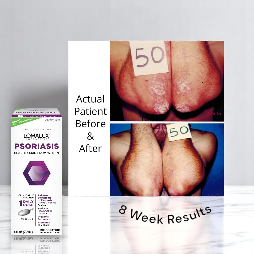 8 oz Psoriasis & Seborrheic Dermatitis Relief N7703